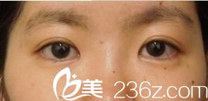 我的眼里有星星，找橫濱ABE整形外科醫(yī)院找阿部圣孝為我做的埋線雙眼皮