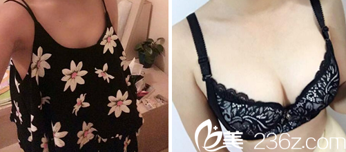 羅盛康隆胸失敗修復案例效果圖