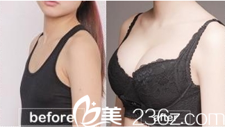 北京美萊隆胸<span style=