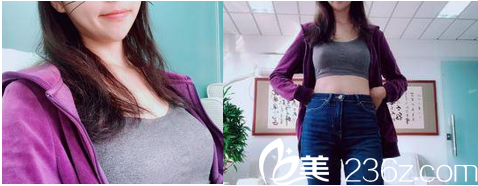 在北京美萊做脂肪豐胸第45天效果 在北京美萊做脂肪豐胸第45天效果