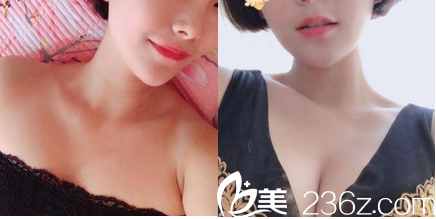 北京京韓喬愛生自體脂肪隆胸案例