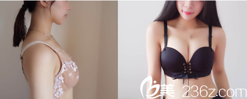 北京京韓王沛森脂肪豐胸案例