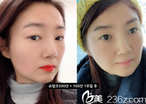 PPEUM醫(yī)院提升+瘦臉除皺 PPEUM醫(yī)院提升+瘦臉除皺