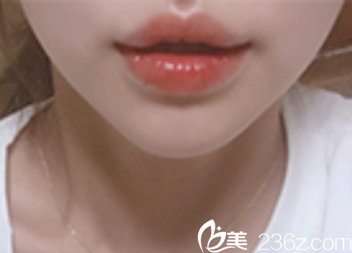 PPEUM醫(yī)院嘴唇填充 PPEUM醫(yī)院嘴唇填充