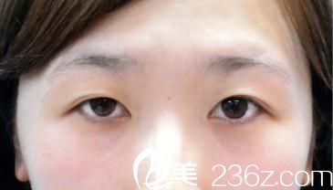 竹內(nèi)重夫埋線雙眼皮前 竹內(nèi)重夫埋線雙眼皮前