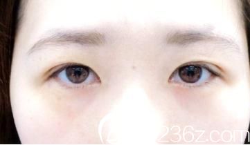 想去日本做效果自然的埋線雙眼皮，多方對比后選擇了宇都宮醫(yī)院的竹內(nèi)重夫醫(yī)生。