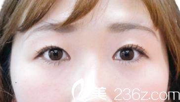 竹內(nèi)重夫埋線雙眼皮術(shù)后兩個月 竹內(nèi)重夫埋線雙眼皮術(shù)后兩個月