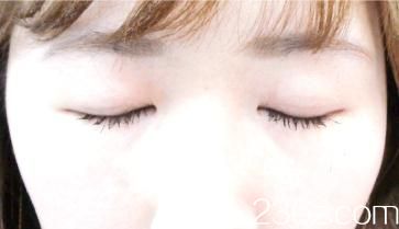竹內(nèi)重夫埋線雙眼皮術(shù)后兩個月 竹內(nèi)重夫埋線雙眼皮術(shù)后兩個月