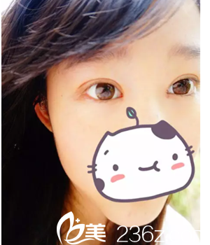 我在韓國(guó)留學(xué)，跟風(fēng)也在韓國(guó)必當(dāng)歸做了雙眼皮手術(shù)，分享下術(shù)后1-10天的恢復(fù)照片