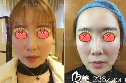 注射玻尿酸瘦臉即刻對比圖