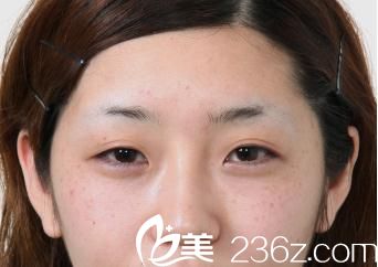 開內(nèi)眼角手術(shù)前 開內(nèi)眼角手術(shù)前