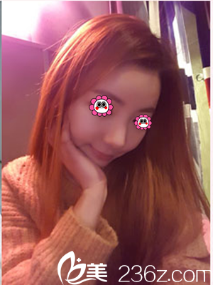 柳濟圣給我做隆鼻后手術(shù)一個月了 柳濟圣給我做隆鼻后手術(shù)一個月了