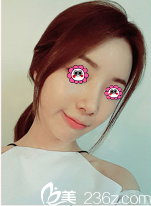 做完硅膠隆鼻+鼻中隔軟骨墊鼻尖后我是這樣護(hù)理的，必當(dāng)歸柳濟(jì)圣院長(zhǎng)說我恢復(fù)的比別人快