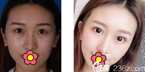 伊思整形醫(yī)生三眼皮修復(fù)+自體軟骨隆鼻效果案例 伊思整形醫(yī)生三眼皮修復(fù)+自體軟骨隆鼻效果案例