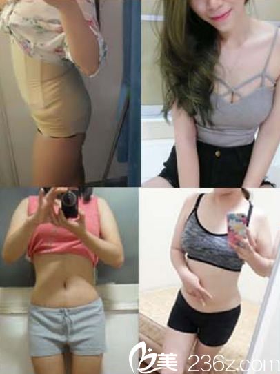 寧波童顏整形腰腹吸脂和脂肪隆胸案例