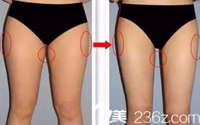腿部吸脂案例