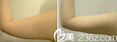 寧波童顏整形手臂抽脂案例