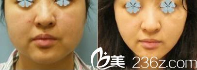 寧波童顏面部吸脂案例效果圖