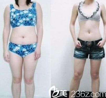 全身吸脂減肥案例