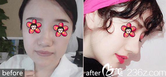 <!--<i data=20240703-sp></i>-->整形醫(yī)院隆鼻案例