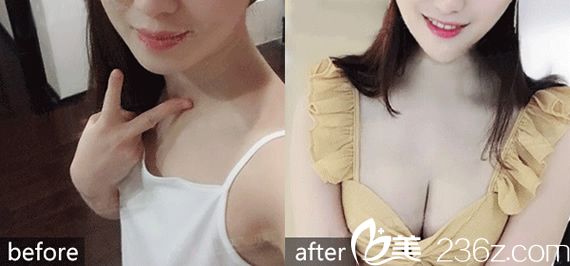 <!--<i data=20240703-sp></i>-->整形醫(yī)院隆胸案例