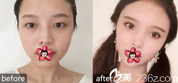 <!--<i data=20240703-sp></i>-->整形醫(yī)院雙眼皮案例