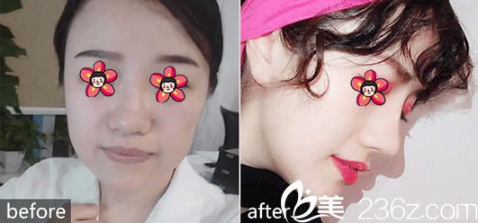 整形馮利光鼻綜合案例 整形馮利光鼻綜合案例