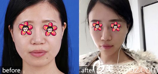 謝劍自體脂肪填充案例 謝劍自體脂肪填充案例