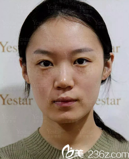 祛斑術(shù)前照片 祛斑術(shù)前照片