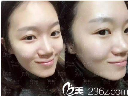 yestar超皮秒祛斑術(shù)后10天 yestar超皮秒祛斑術(shù)后10天