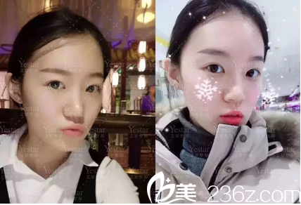 深圳yestar超皮秒祛斑案例圖片 深圳yestar超皮秒祛斑案例圖片