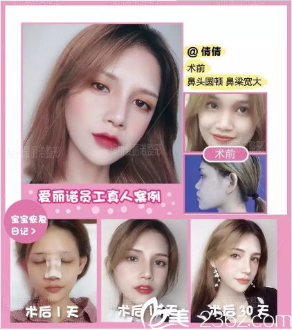 梅州愛(ài)麗諾隆鼻案例