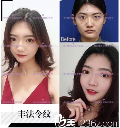 梅州愛(ài)麗諾玻尿酸面部填充案例