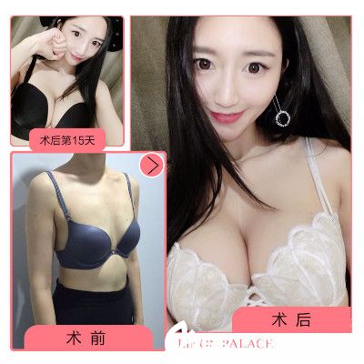 梅州愛(ài)麗諾醫(yī)療美容醫(yī)院隆胸案例