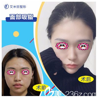 成都艾米麗潘紅偉吸脂變化圖 成都艾米麗潘紅偉吸脂變化圖