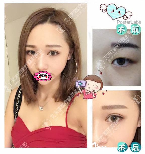 成都艾米麗醫(yī)院孫歡雙眼皮效果圖 成都艾米麗醫(yī)院孫歡雙眼皮效果圖