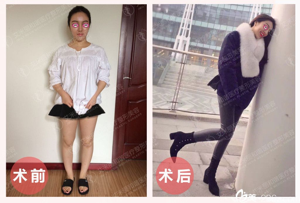 成都艾米麗院長(zhǎng)抽脂前后對(duì)比圖 成都艾米麗院長(zhǎng)抽脂前后對(duì)比圖