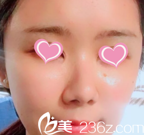 恢復20天后的面部情況