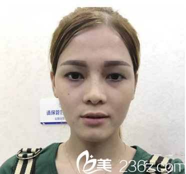 術(shù)前單眼皮照片 術(shù)前單眼皮照片