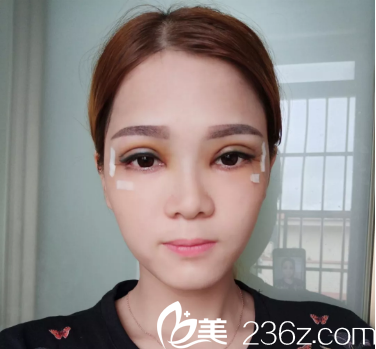 范丹醫(yī)生全切雙眼皮術(shù)后三天 范丹醫(yī)生全切雙眼皮術(shù)后三天