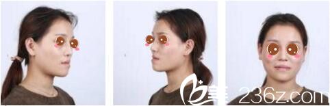 韓國女神整形醫(yī)院金鎮(zhèn)亨下頜角磨骨真人案例術(shù)前照 韓國女神整形醫(yī)院金鎮(zhèn)亨下頜角磨骨真人案例術(shù)前照