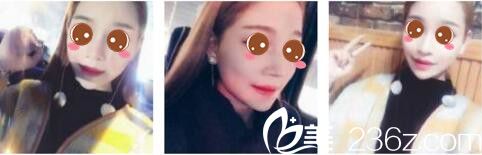 韓國女神整形醫(yī)院金鎮(zhèn)亨下頜角磨骨真人案例術(shù)后一個月 韓國女神整形醫(yī)院金鎮(zhèn)亨下頜角磨骨真人案例術(shù)后一個月