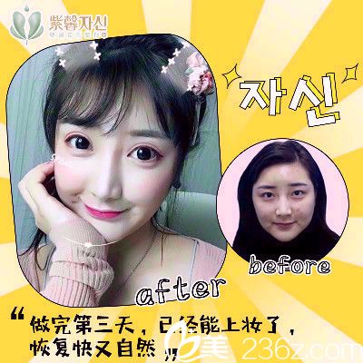 廣州紫馨李政祐雙眼皮案例 廣州紫馨李政祐雙眼皮案例