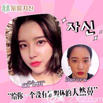 廣州紫馨李政祐雙眼皮隆鼻案例 廣州紫馨李政祐雙眼皮隆鼻案例