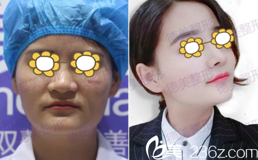 鼻整形真人前后對比