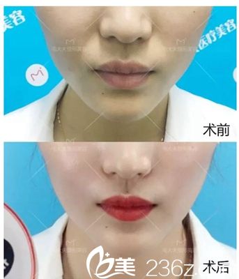 洛陽毛大夫喬雅登玻尿酸注射除法令紋