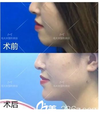 洛陽毛大夫喬雅登玻尿酸填充下巴案例