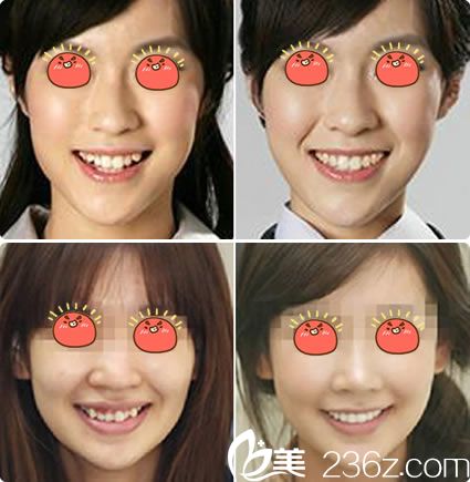 寧波薇琳虞淑華隱形矯正案例 寧波薇琳虞淑華隱形矯正案例