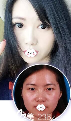 淮北相山時(shí)光劉家賀雙眼皮案例效果對(duì)比圖