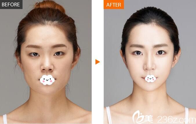 淮北相山時(shí)光王鋒鼻綜合隆鼻案例